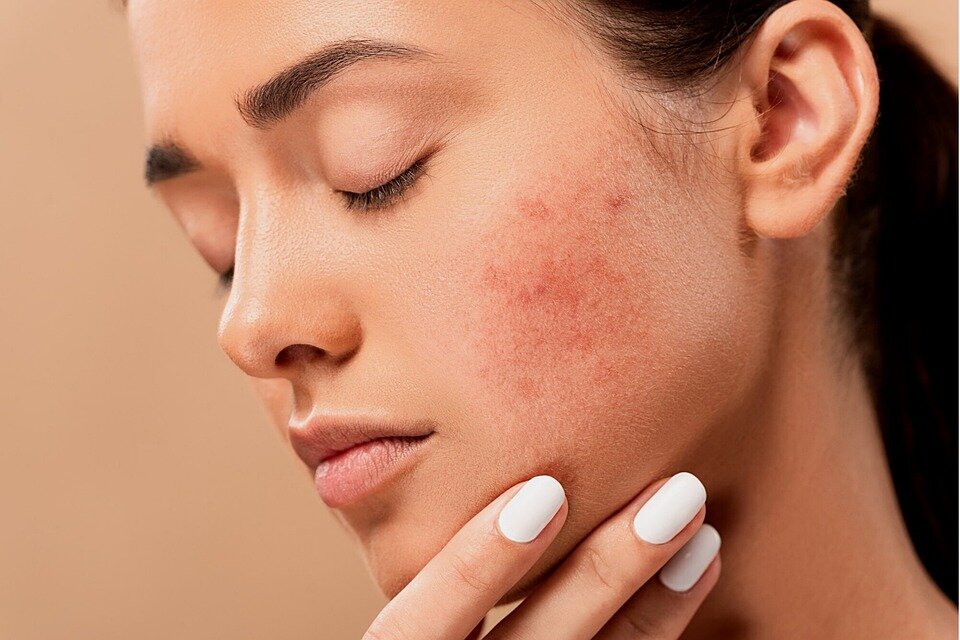 Perché coprire i brufoli con il trucco se puoi eliminarli?