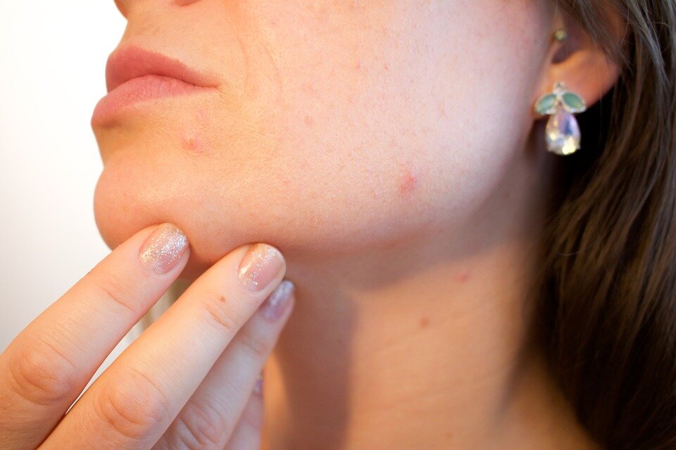 La skincare infallibile per ridurre le macchie rosse post brufolo